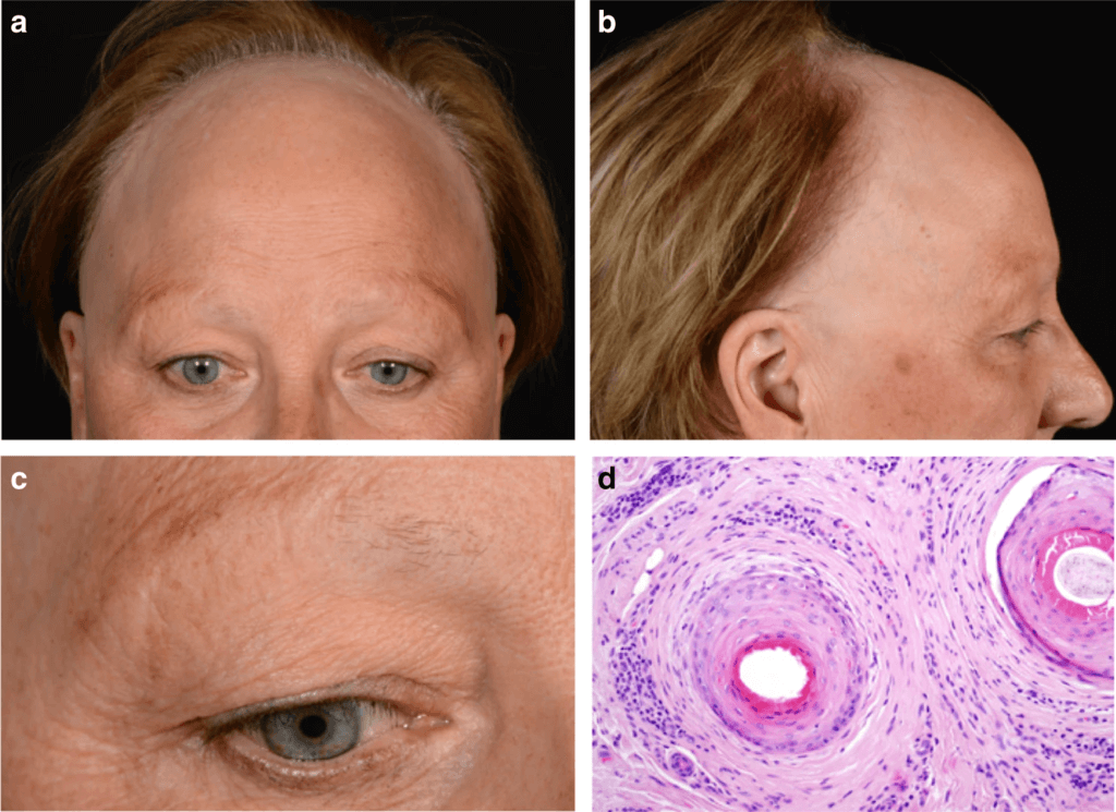 medical reasons for eyebrow hair loss