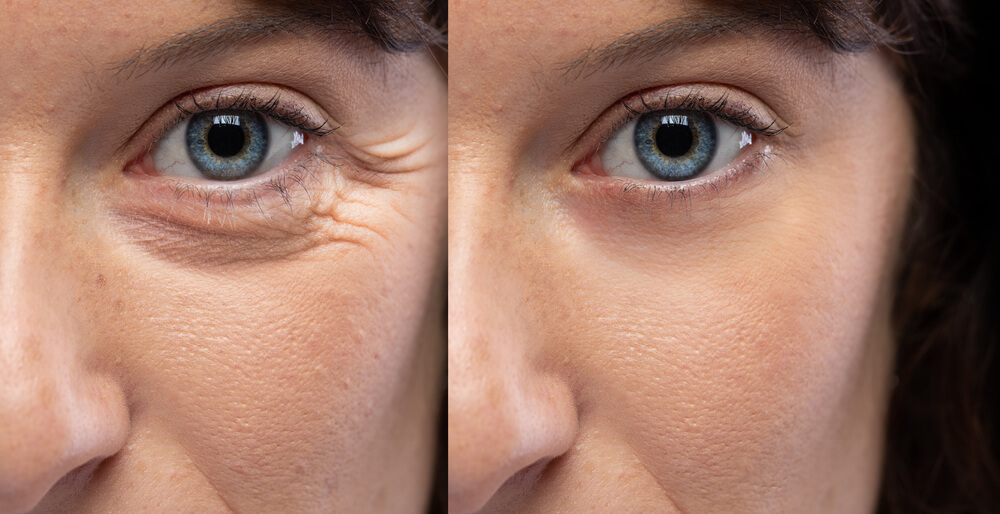 3 areas of botox before and after