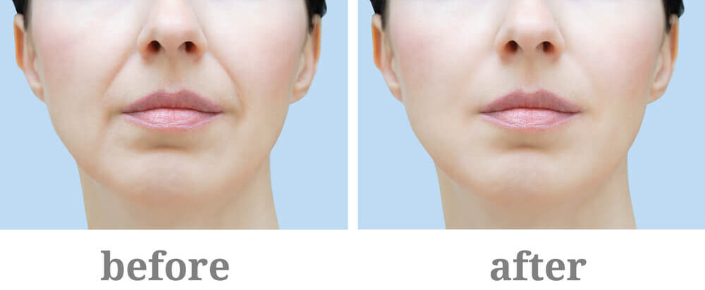 botox injection sites face diagram