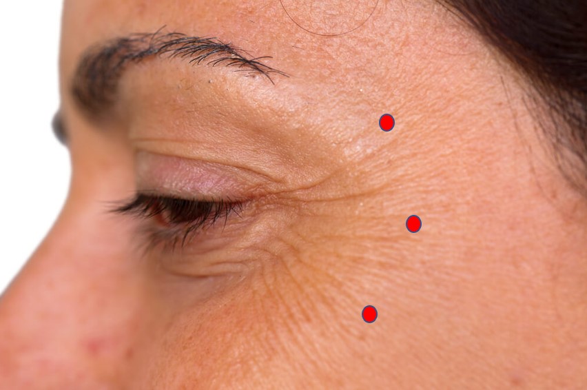 which areas for botox